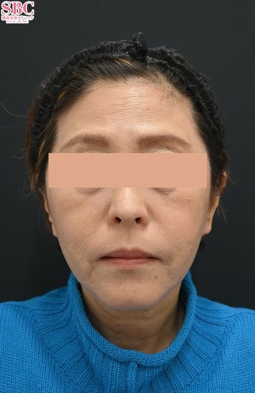 【女性・たるみ】プロファイロ_before