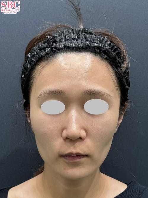 【30代女性・輪郭】ナチュラル脂肪注射コンデンスリッチ コンデンスリッチフェイス脂肪注入全顔入れ放題_before