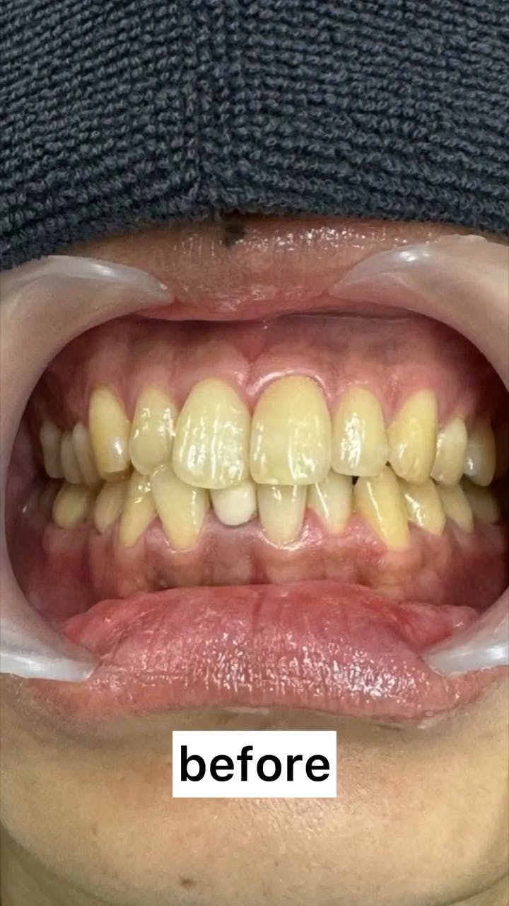 【歯】ホワイトニング_before