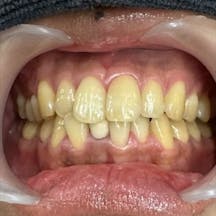 【歯】ホワイトニング_before