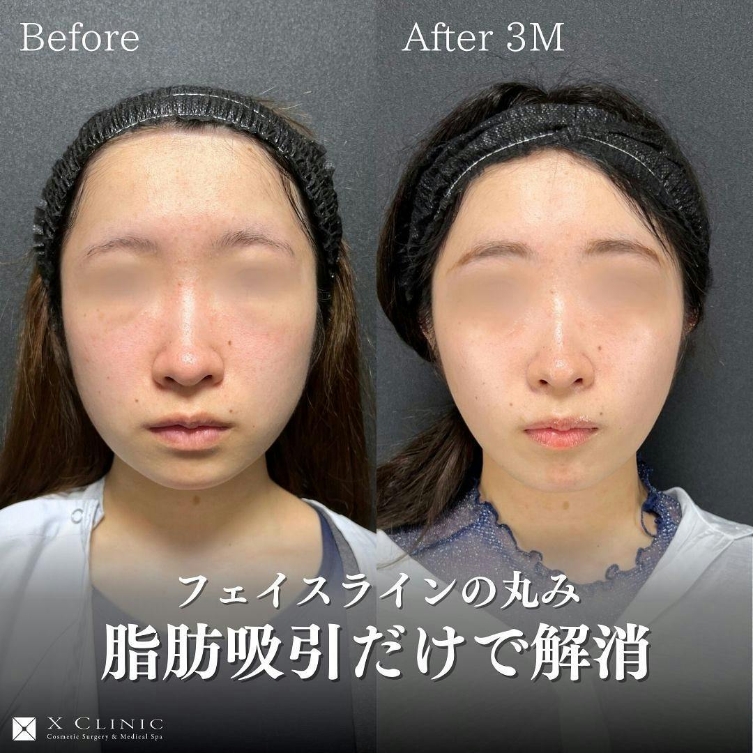 【20代前半女性・輪郭】糸リフト_before_aftar