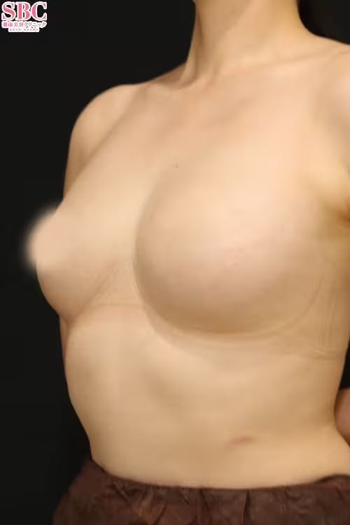 【30代前半女性・胸】セルーション(脂肪注入豊胸)、コールマン式、3Dプレミアム注入法（垂直注入法）（脂肪注入豊胸オプション）_after