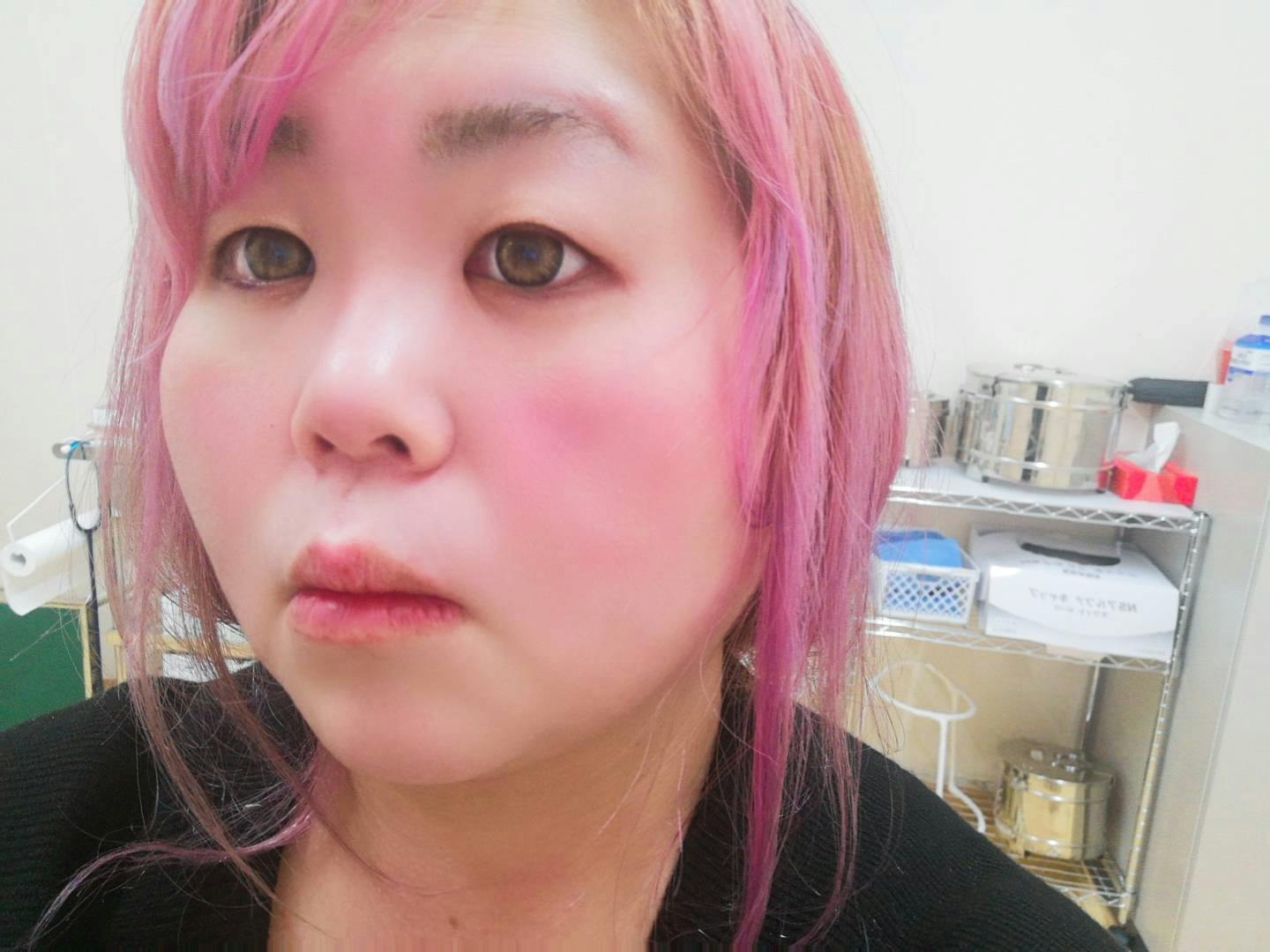 いわきタウン形成外科クリニックで二重まぶた埋没法を受けたまいまいさんの写真