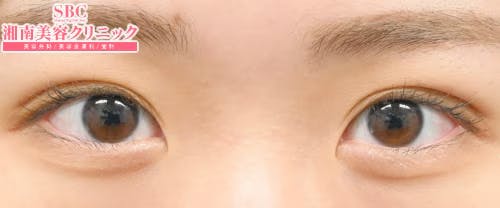 【女性・目元】クイックコスメティーク・トリプルNeo_after