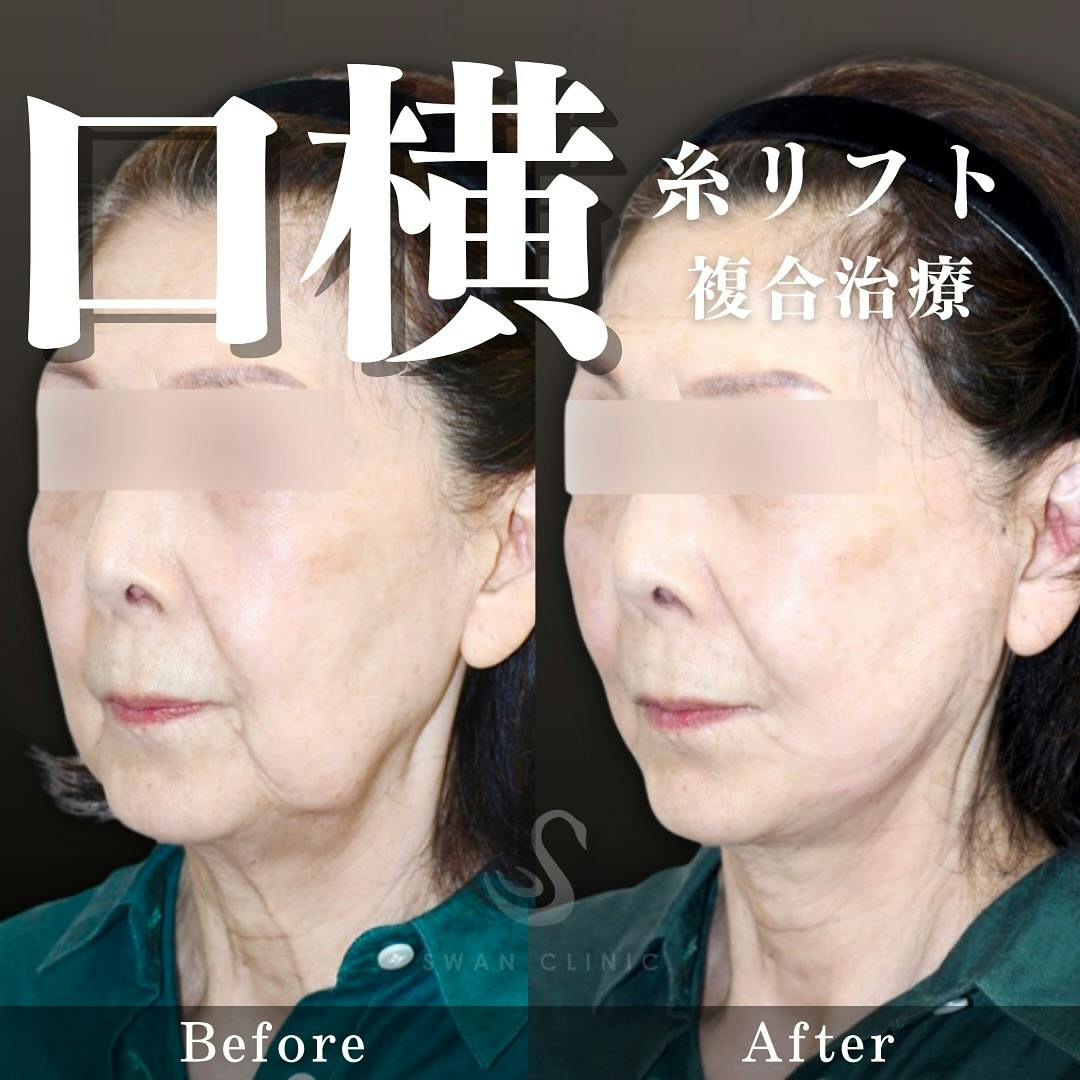 【女性・口元】糸リフト 口横サーマジェン ロ角ヒアルロン酸注入_before_aftar