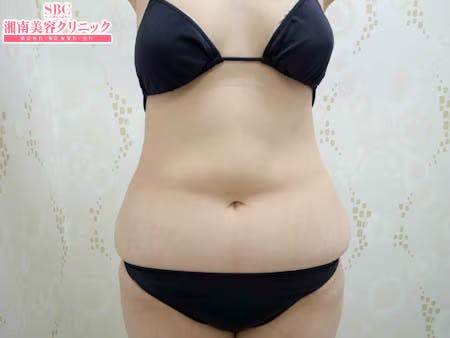 【女性・腹部】根こそぎVASER脂肪吸引、ライポマティック脂肪吸引、Aquicell（アキーセル）脂肪吸引_before