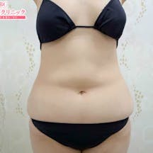 【女性・腹部】根こそぎVASER脂肪吸引、ライポマティック脂肪吸引、Aquicell(アキーセル)脂肪吸引_before