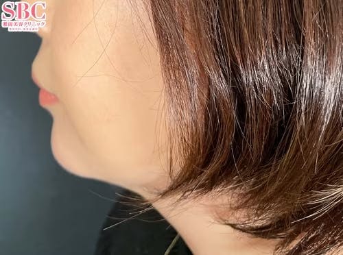 【女性・顎】ヒアルロン酸_after