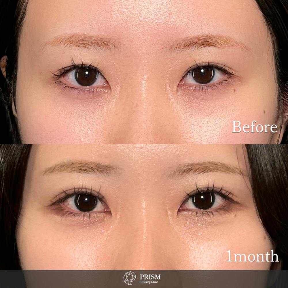 【20代女性・目】PRISM 1day二重埋没 ナチュラル 4点留め_before_aftar