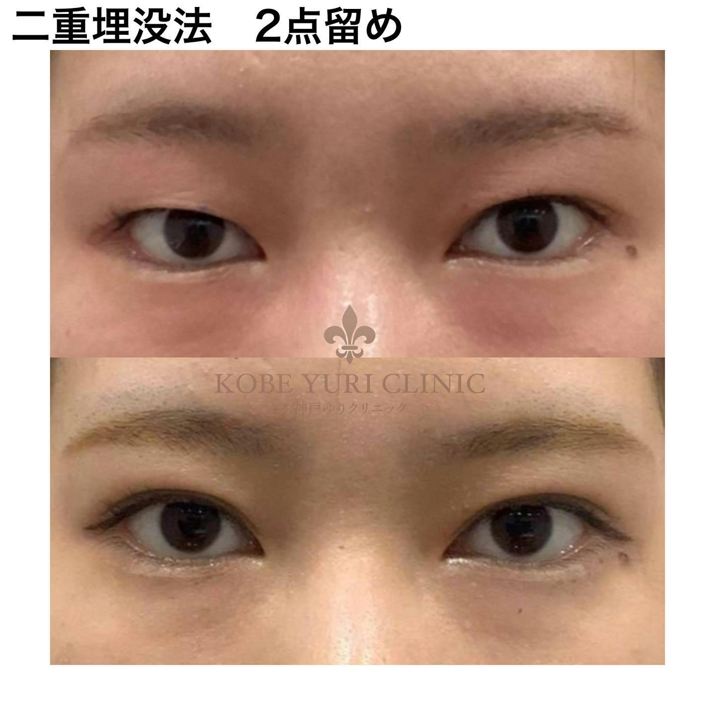 【女性・目元】二重埋没法 2点どめ_before_aftar