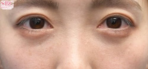 【女性・目元】目の下の切らないクマ・たるみ（ふくらみ）取り、ナチュラル脂肪注射コンデンスリッチ、ナチュラル脂肪注射ナノリッチ_aftar