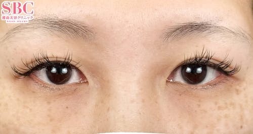 【女性・目元】クイックコスメティーク・トリプルNeo_before