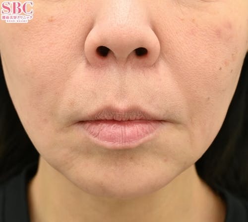 【女性・口元】切らない人中短縮、切らない口角挙上_before