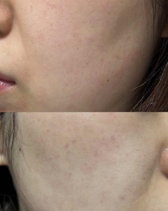 東京形成美容外科 船橋院でレーザートーニングを受けたTiさんの写真
