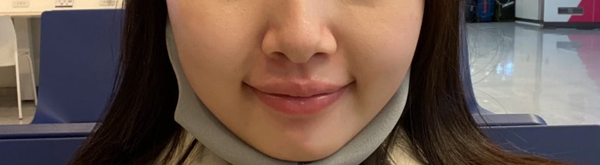 リエンジャン美容外科 江南本店で口角ボトックスを受けたもぐもぐさんの写真