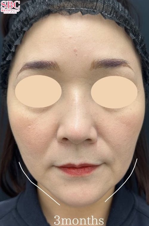 【40代女性・たるみ】シークレットリフト・VOV（ボブ）リフト・ヒアルロン酸ジュビダームビスタ バイクロスシリーズ_after