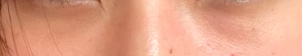 カリスビューティークリニック(CHARIS BEAUTY CLINI)でクマ取りを受けたはるさんの写真