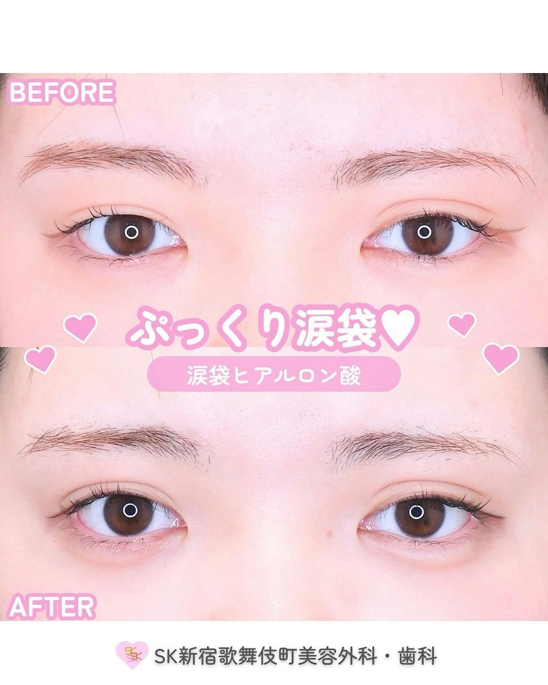 【女性・目元】涙袋ヒアルロン酸_before_aftar