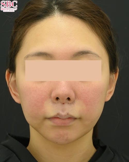 【女性・口元】切らない人中短縮_justafter