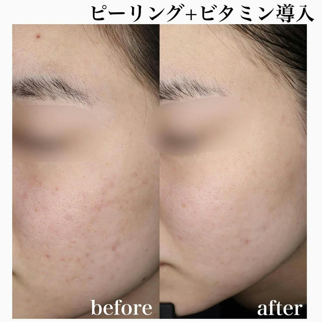 【女性・顔】ピーリング＋ビタミン導入_before_aftar