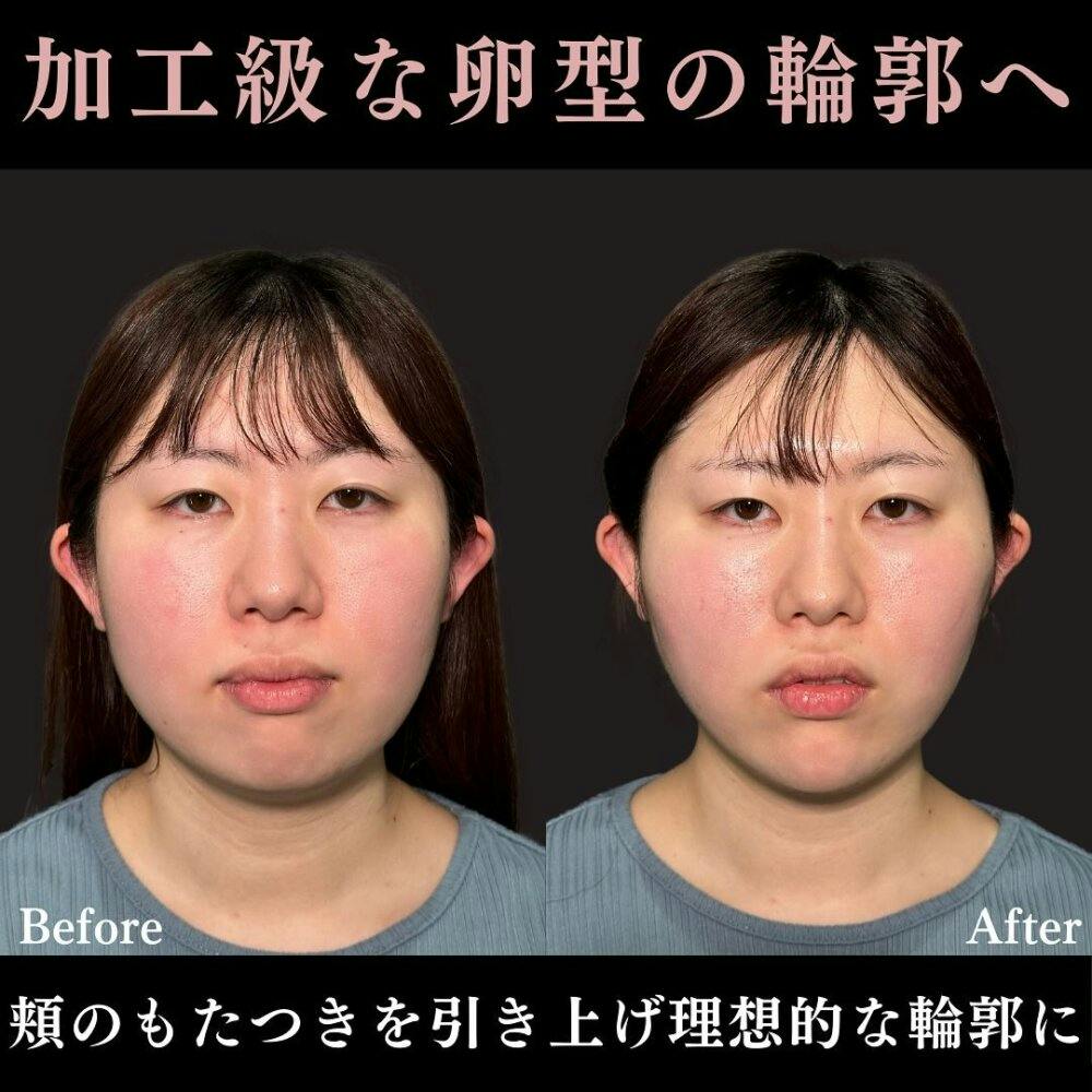 【20代女性・顔】PRISM小顔リフト・あご先リフト_before_aftar