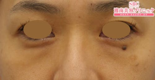 【女性・目元】目の下の切らないクマ・たるみ（ふくらみ）取り、ナチュラル脂肪注射_before