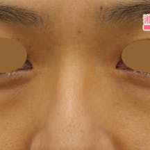 【女性・目元】目の下の切らないクマ・たるみ(ふくらみ)取り、ナチュラル脂肪注射_before