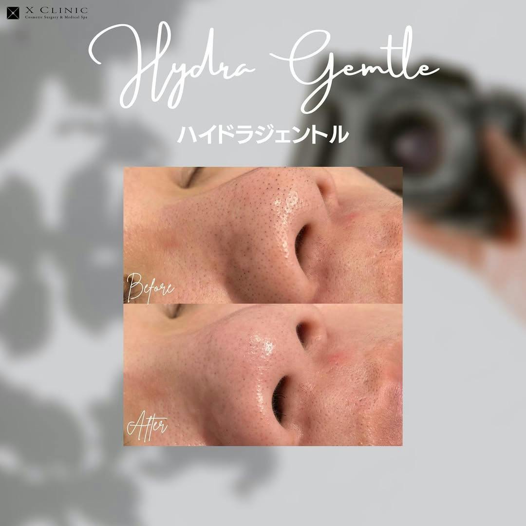 【男性・毛穴】ハイドラジェントル_before_aftar