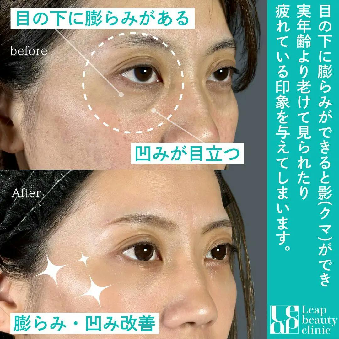 【30代女性・目元】裏ハムラ法_before_aftar