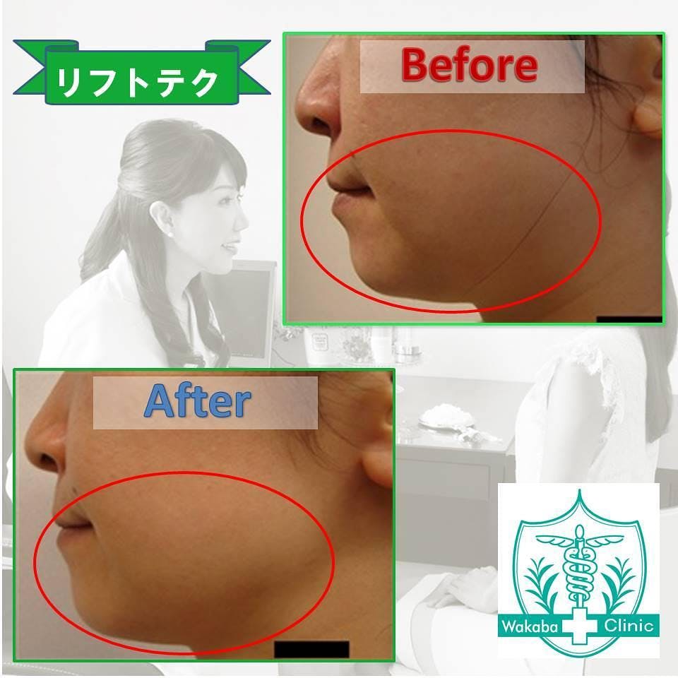 【女性・たるみ】ＹＡＧレーザー_before_aftar