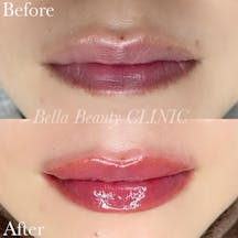【女性・唇】リップアートメイク_before_aftar