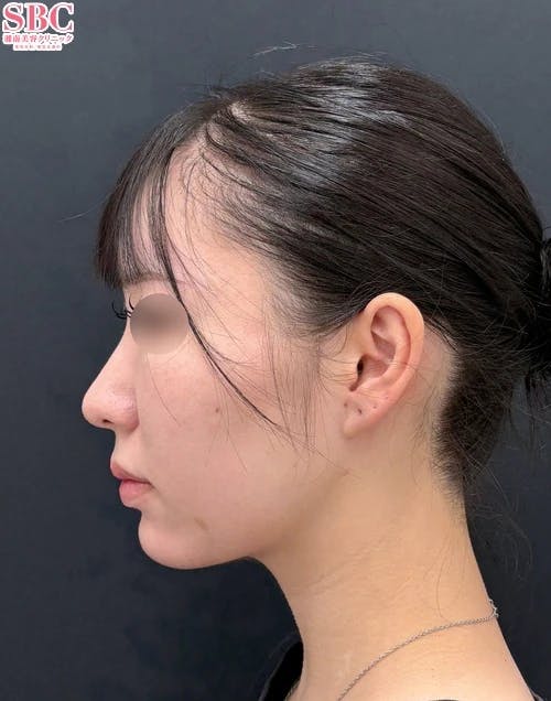 【20代女性・顔・頬・顎下】メーラーファット除去術・Aquicell(アキーセル)脂肪吸引・根こそぎVASER脂肪吸引_after