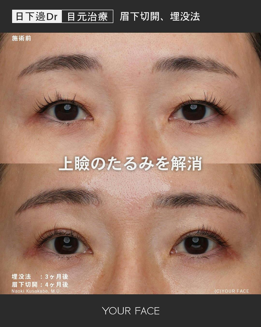 【女性・目元】埋没法（BDTS法）_before_aftar