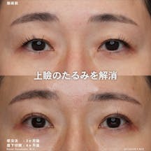 【女性・目元】埋没法(BDTS法)_before_aftar