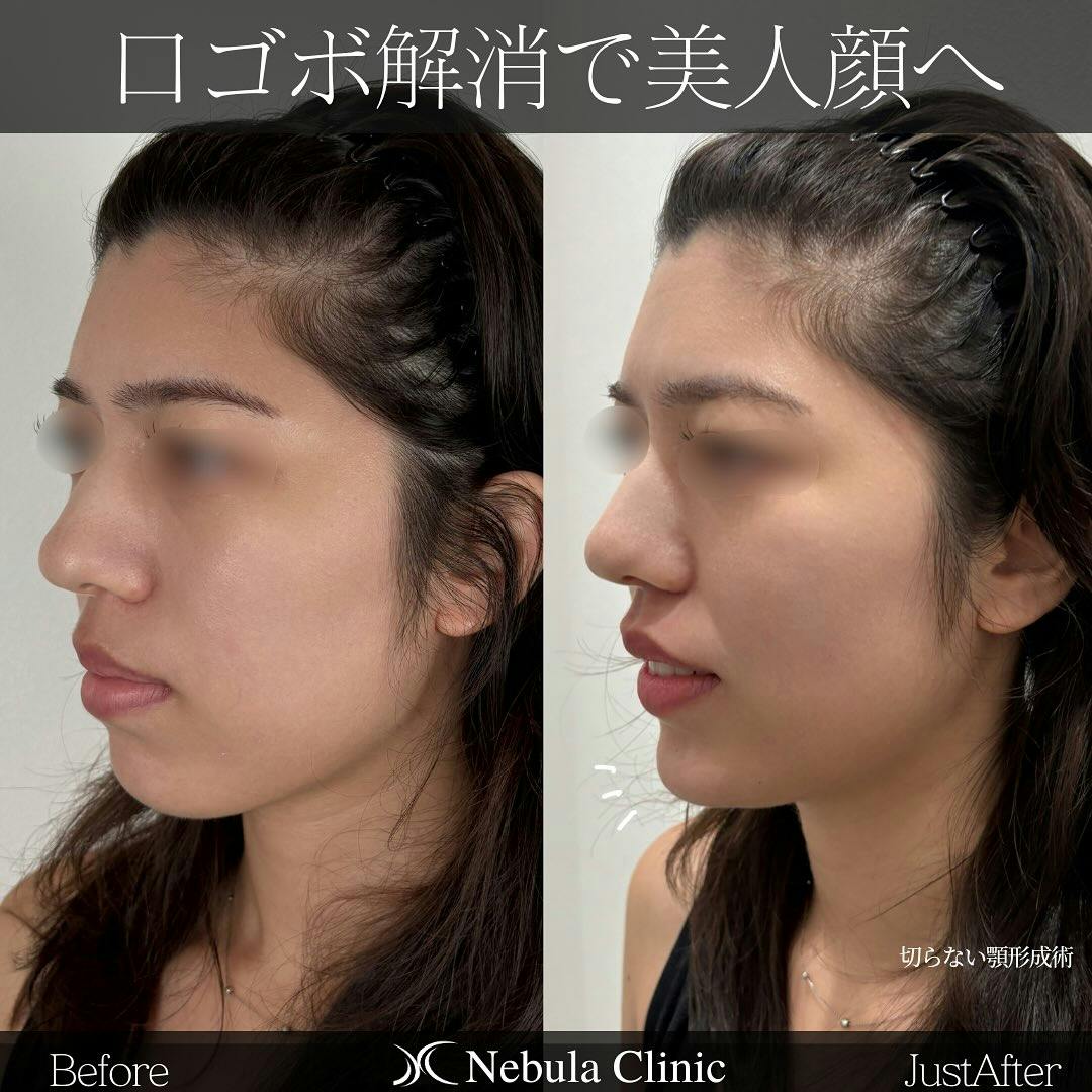 【女性・顎】切らない顎形成術_before_aftar