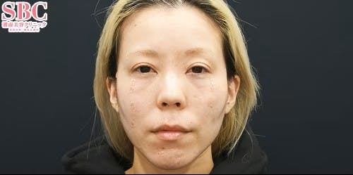 【女性・目元・顔】目の下の切らないクマ・たるみ（ふくらみ）取り、ナチュラル脂肪注射コンデンスリッチ、ナチュラル脂肪注射ナノリッチ、VOVリフト_after