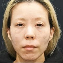 【女性・目元・顔】目の下の切らないクマ・たるみ(ふくらみ)取り、ナチュラル脂肪注射コンデンスリッチ、ナチュラル脂肪注射ナノリッチ、VOVリフト_after