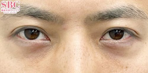 【30代男性・目元】目の下の切らないクマ・たるみ（ふくらみ）取り、ナチュラル脂肪注射ナノリッチ_after