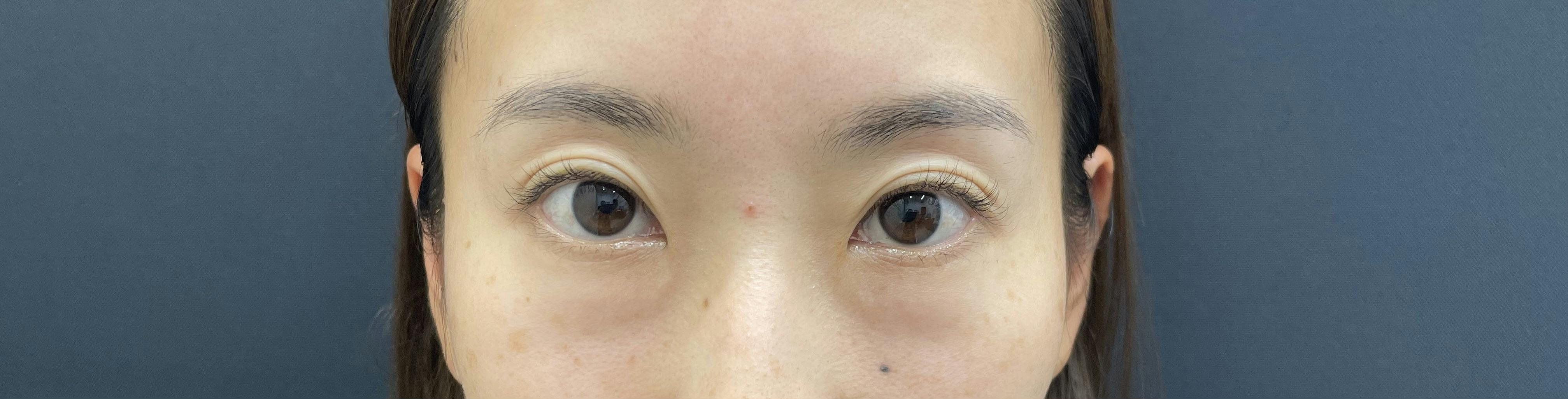 湘南美容クリニック 辻堂アカデミアで目の下のクマ・たるみ取りを受けたKazuminさんの写真