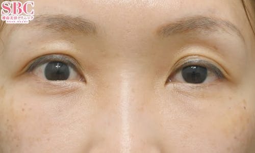 【30代女性・たるみ】目の下の切らないクマ・たるみ（ふくらみ）取り ナチュラル脂肪注射コンデンスリッチ ナチュラル脂肪注射ナノリッチ_after