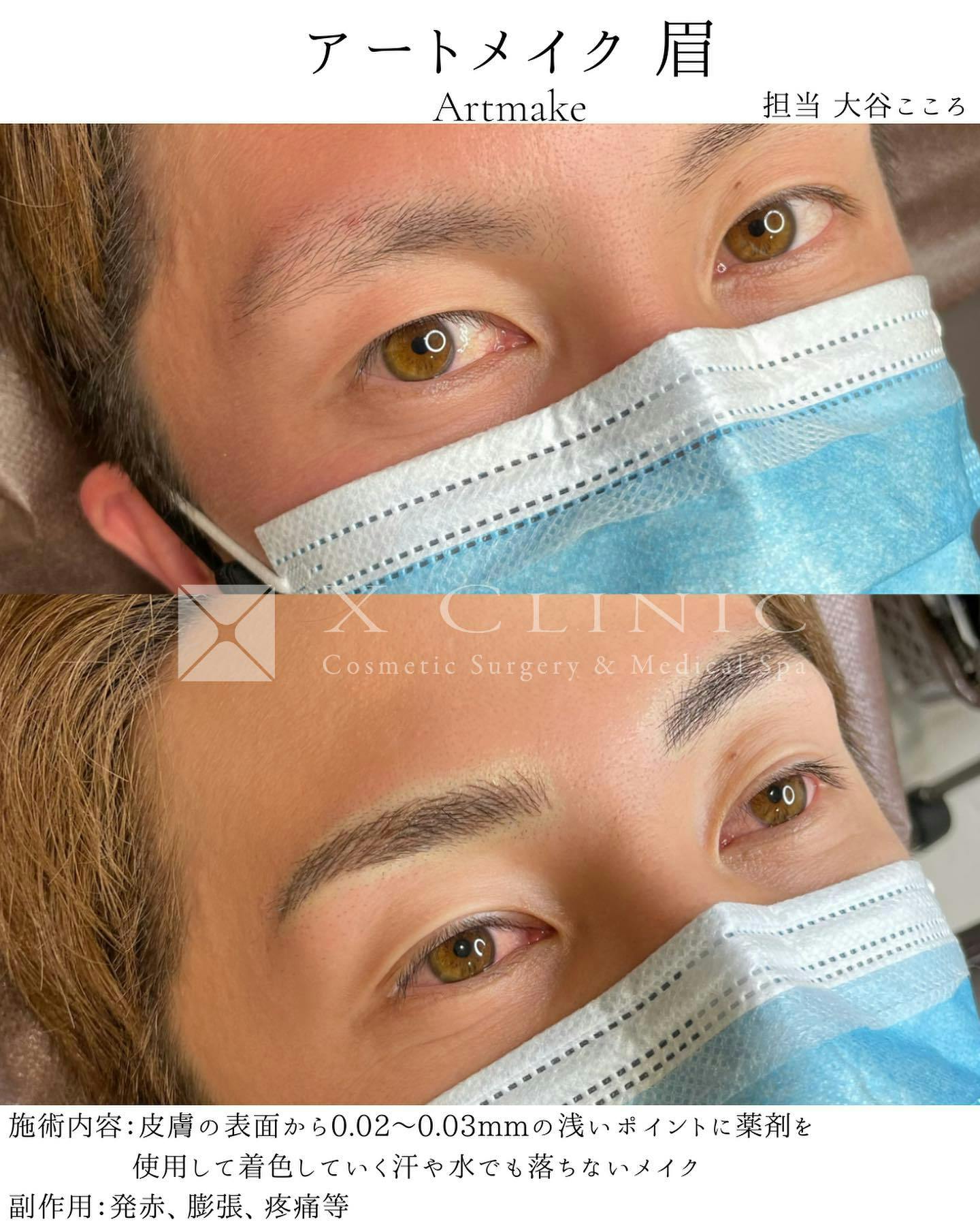 【男性・眉】眉毛アートメイク_before_aftar