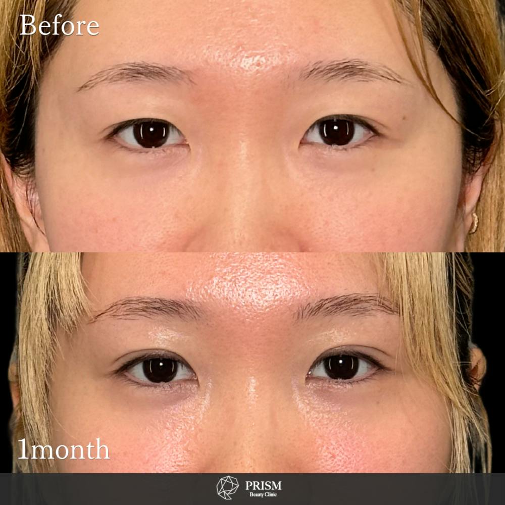 【20代女性・目】PRISM 1day二重埋没 ナチュラル 4点留め_before_aftar