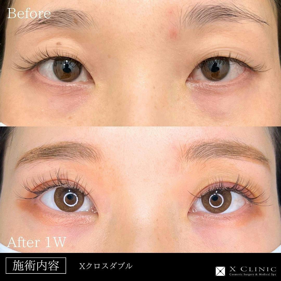 【20代女性・目元】Xクロスダブル_before_aftar