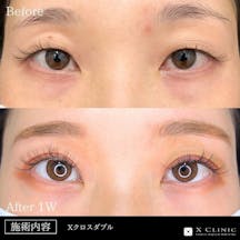 【20代女性・目元】Xクロスダブル_before_aftar