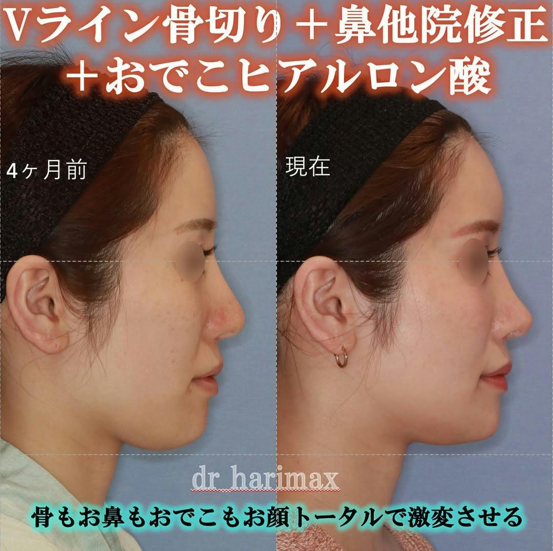 【女性・顎・鼻・おでこ】Vライン骨切り・鼻骨骨切り・鼻中隔延長・肋軟骨採取・隆鼻術・他院修正・おでこヒアルロン酸ボリューマ2CC_before_aftar