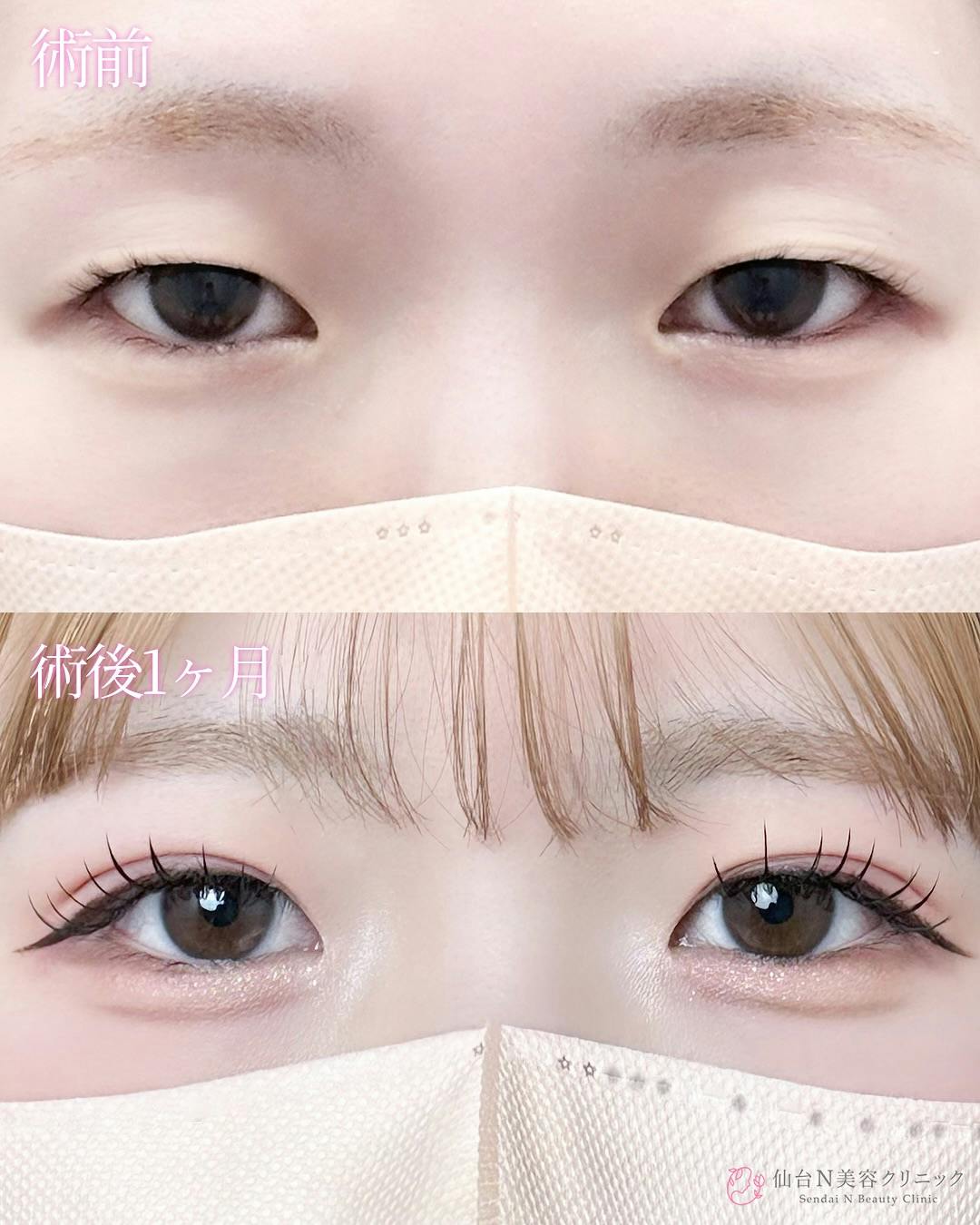 【女性・目元】二重埋没法（シークレットトリプル）_before_aftar