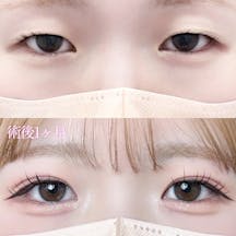 【女性・目元】二重埋没法(シークレットトリプル)_before_aftar