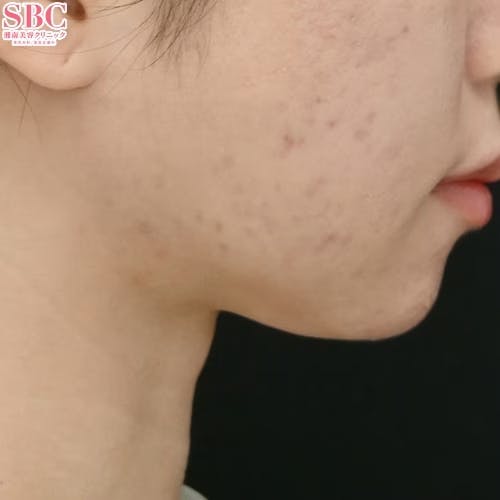 【女性・輪郭】エンブレイスRF・Aquicell（アキーセル）脂肪吸引・ボトックス_aftar