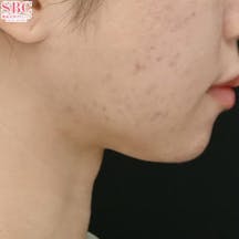 【女性・輪郭】エンブレイスRF・Aquicell(アキーセル)脂肪吸引・ボトックス_aftar