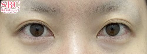 【30代女性・目元】線留めクロス二重術・自然癒着法_before